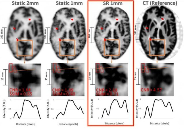 تشخیص آلزایمر با تکنیک جدید در تصویربرداری مغزی