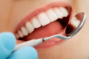 خودکفایی کشور در پرمصرفترین ماده دندانپزشکی