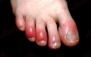 چرا برخی افراد به عارضه «انگشت پای کوویدی» مبتلا می‌شوند