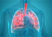 افزایش بروز «آمپیم» به دنبال عفونت‌های تنفسی
