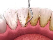جرم دندان‌ سبب تحلیل استخوان فک می‌شود
