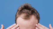 کشف عوامل ریزش مو در مردان
