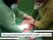 خارج کردن توده ۱۰ کیلویی از بدن بیمار اراکی در بیمارستان تامین‌اجتماعی امام خمینی (ره)