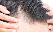 علل ریزش مو و راه‌های جلوگیری از آن